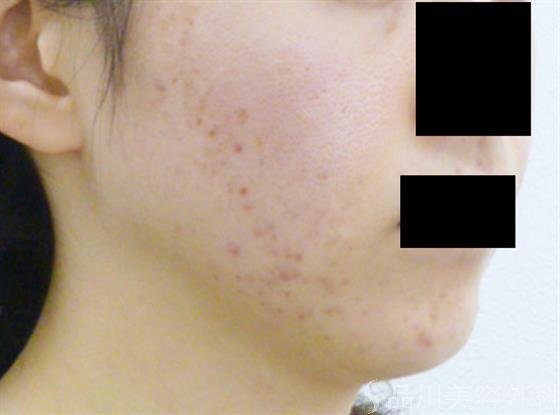 症例NO.24284のBEFORE写真