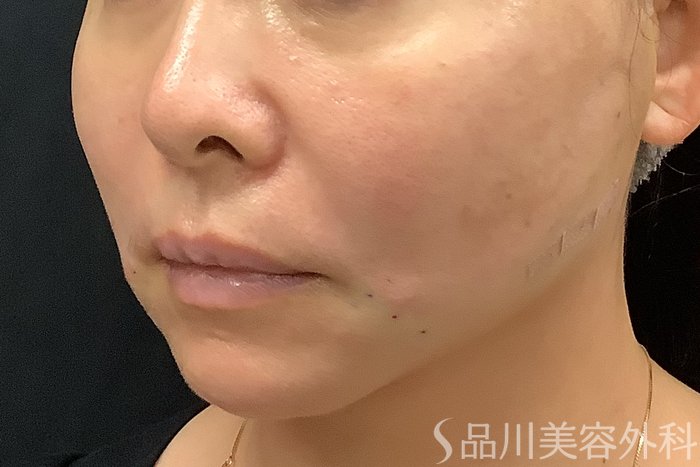 症例NO.71245のAFTER写真