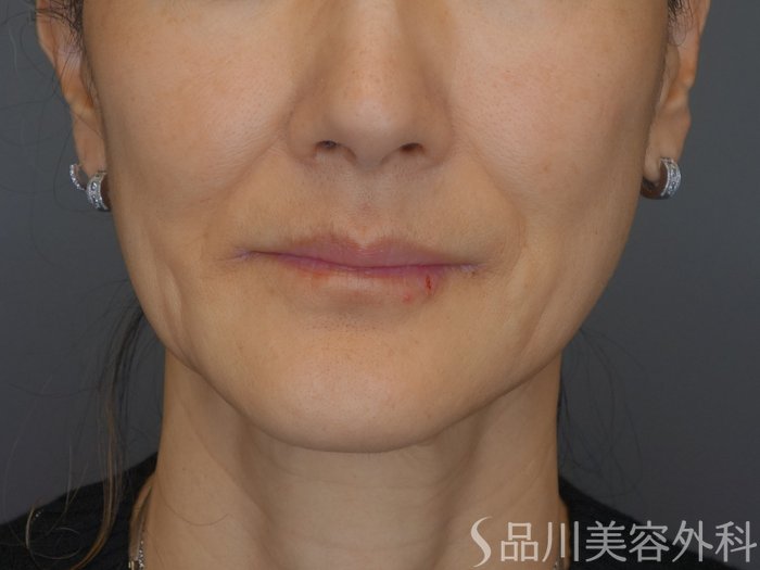 症例NO.72926のBEFORE写真