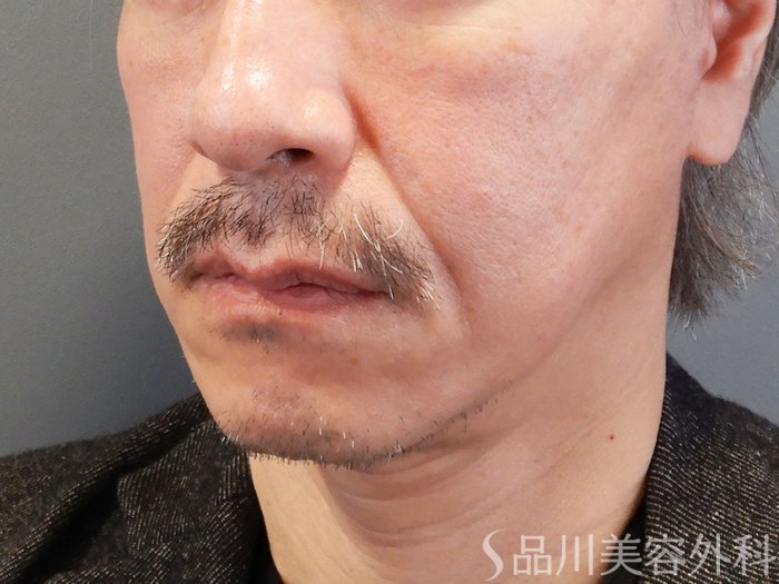症例NO.70468のAFTER写真