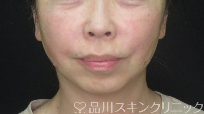 症例NO.72428のAFTER写真