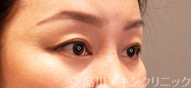 症例NO.71137のBEFORE写真