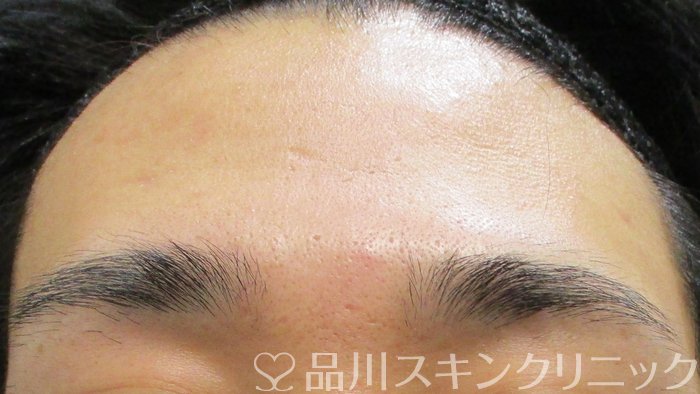 症例NO.70498のAFTER写真
