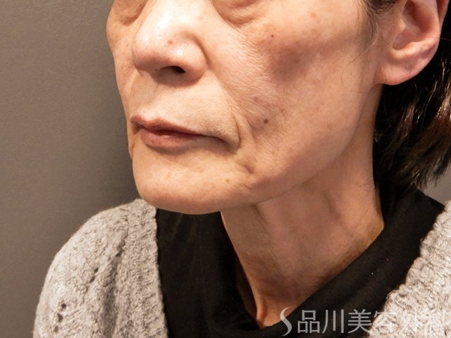 症例NO.67883のBEFORE写真