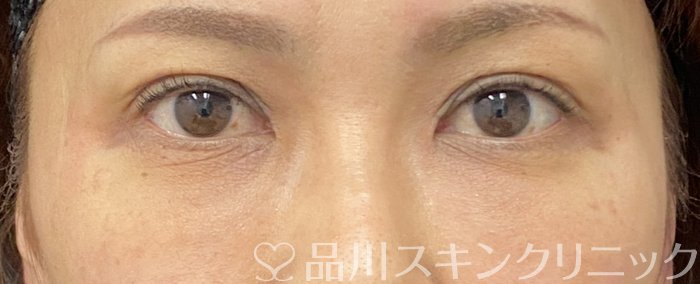 症例NO.74873のAFTER写真