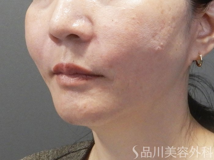 症例NO.72530のAFTER写真