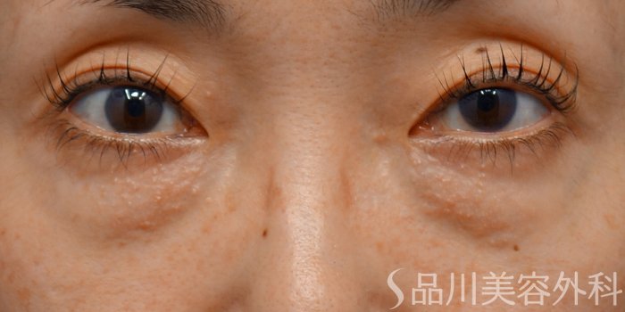 症例NO.72539のBEFORE写真