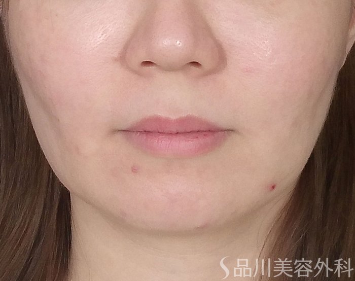 症例NO.69542のBEFORE写真