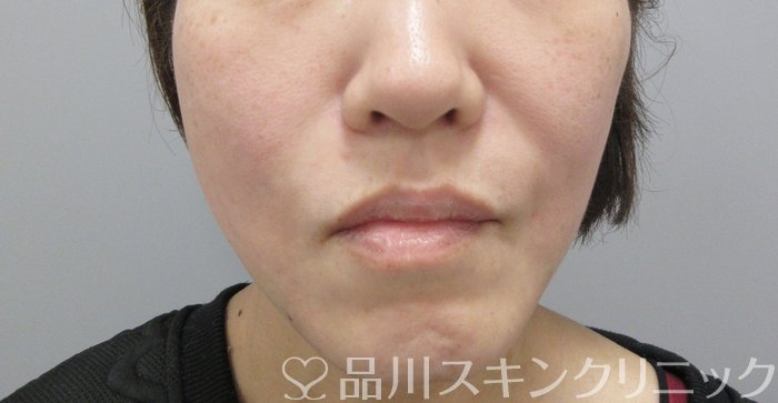 症例NO.69837のAFTER写真