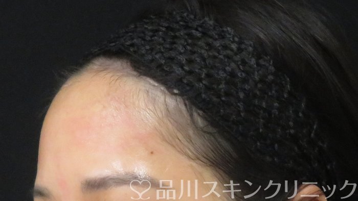 症例NO.70862のBEFORE写真