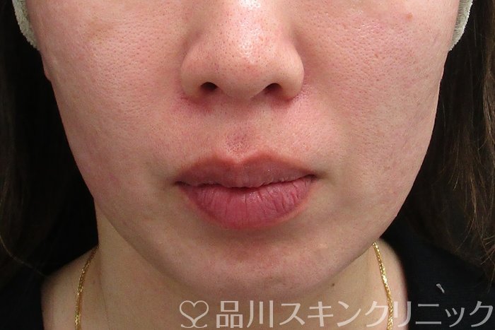 症例NO.73879のBEFORE写真