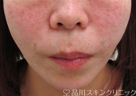 症例NO.35160のAFTER写真