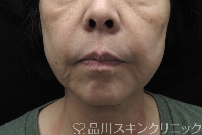 症例NO.74801のBEFORE写真