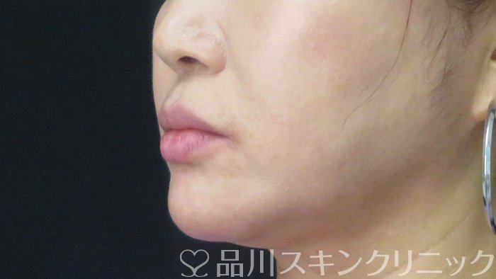 症例NO.72084のBEFORE写真