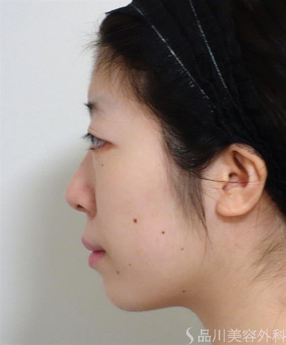症例NO.37615のBEFORE写真