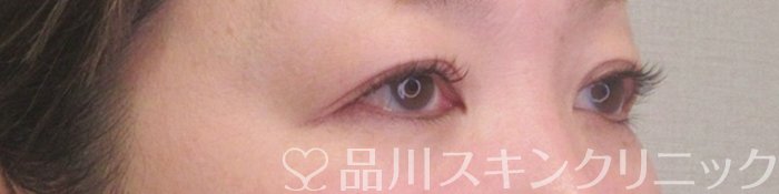 症例NO.73753のAFTER写真