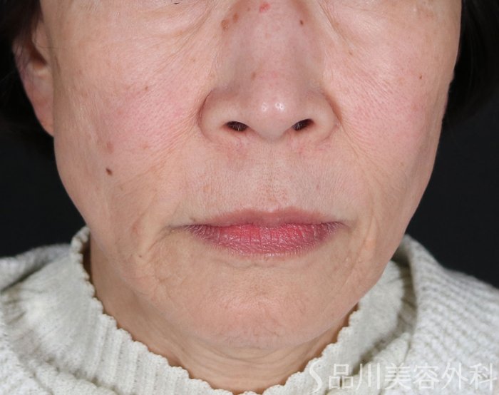 症例NO.72819のBEFORE写真