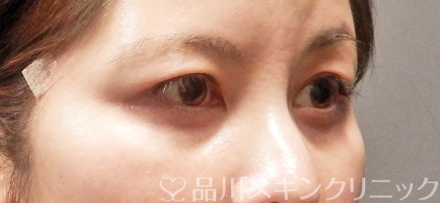 症例NO.63340のBEFORE写真