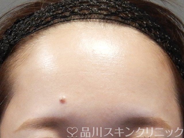 症例NO.64983のBEFORE写真