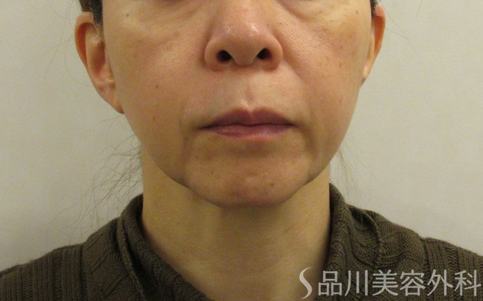 症例NO.70974のBEFORE写真