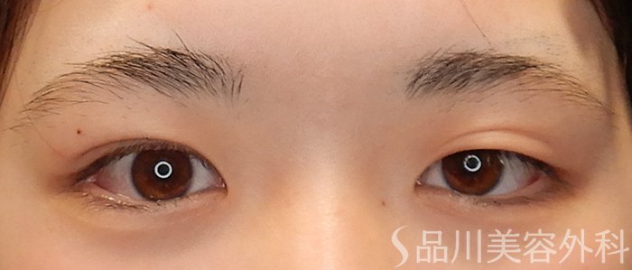症例NO.69305のBEFORE写真