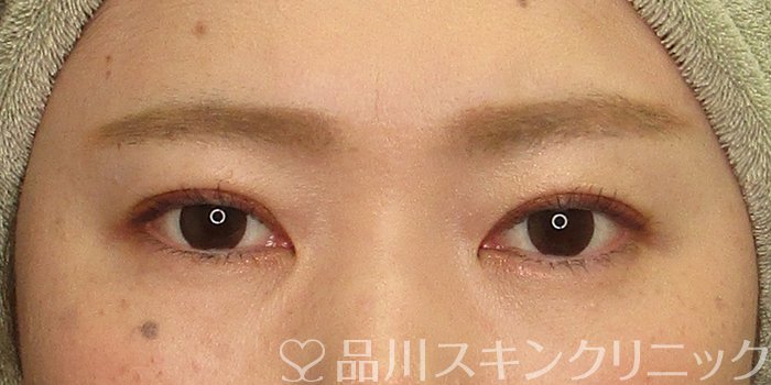 症例NO.69885のAFTER写真