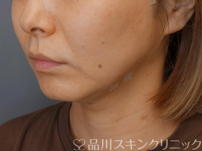症例NO.70865のAFTER写真