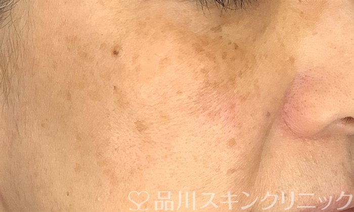 症例NO.72787のBEFORE写真