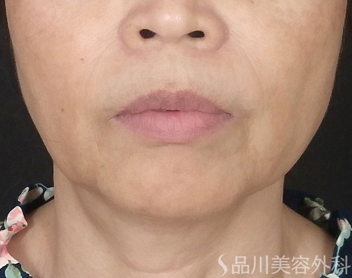 症例NO.69848のBEFORE写真
