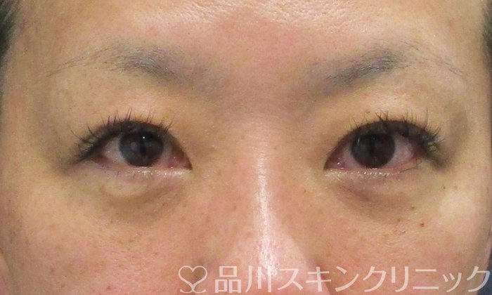 症例NO.69624のAFTER写真