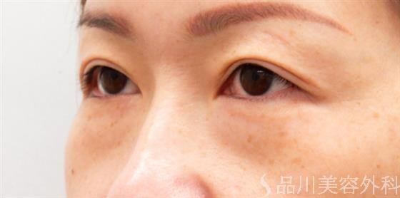 症例NO.53665のBEFORE写真