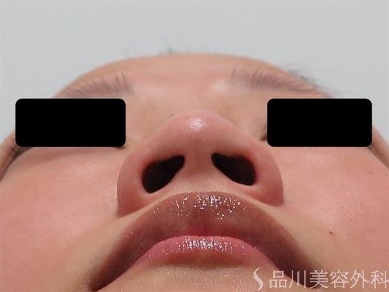 症例NO.45416のBEFORE写真
