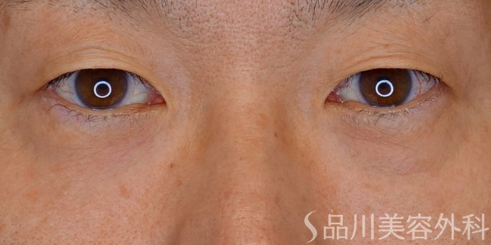 症例NO.71057のBEFORE写真
