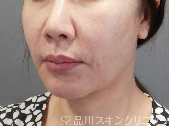 症例NO.75178のBEFORE写真