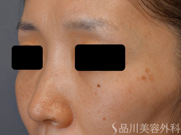 症例NO.73940のBEFORE写真