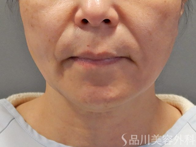 症例NO.73255のAFTER写真