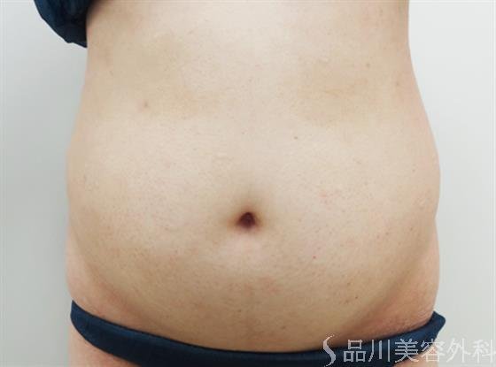 症例NO.23405のBEFORE写真