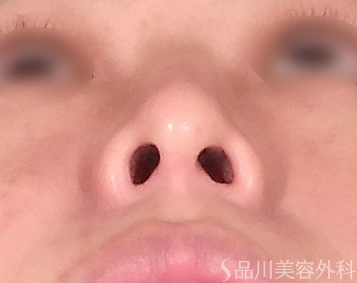 症例NO.69811のBEFORE写真