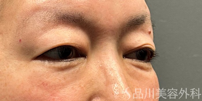 症例NO.74405のBEFORE写真