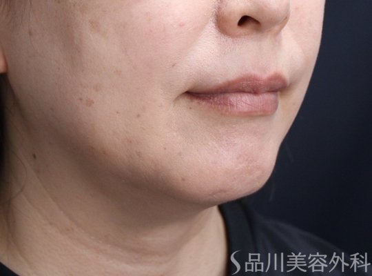 症例NO.71538のAFTER写真