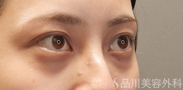 症例NO.74433のBEFORE写真