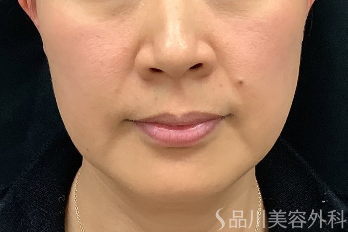 症例NO.73311のBEFORE写真