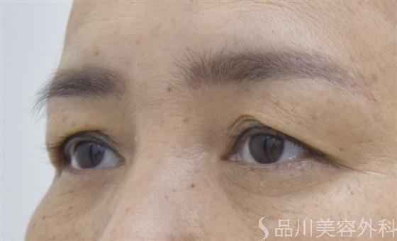 症例NO.53281のBEFORE写真