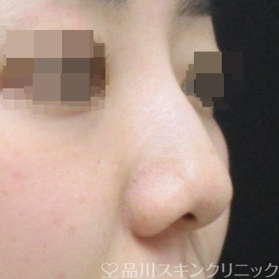 症例NO.70035のBEFORE写真