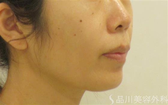 症例NO.61658のBEFORE写真