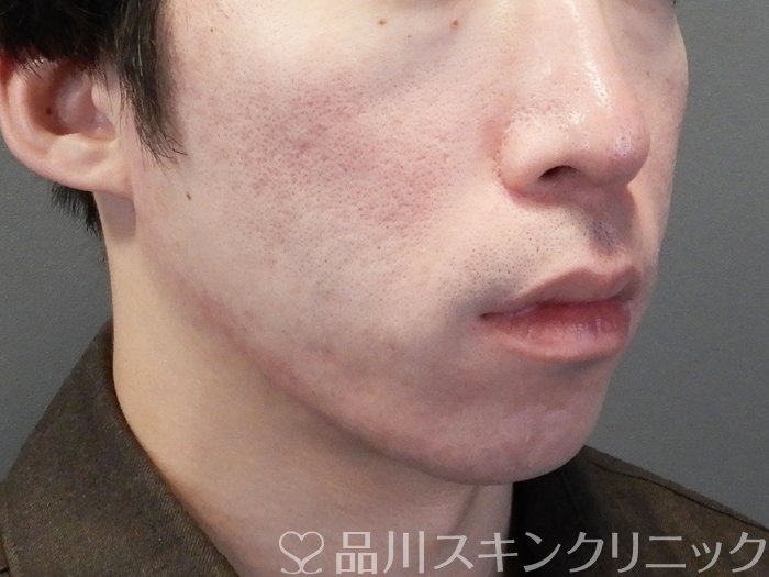 症例NO.69645のAFTER写真