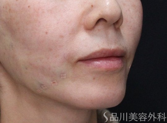 症例NO.72469のAFTER写真