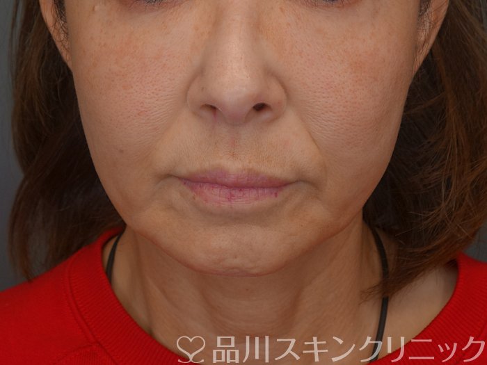 症例NO.74702のBEFORE写真