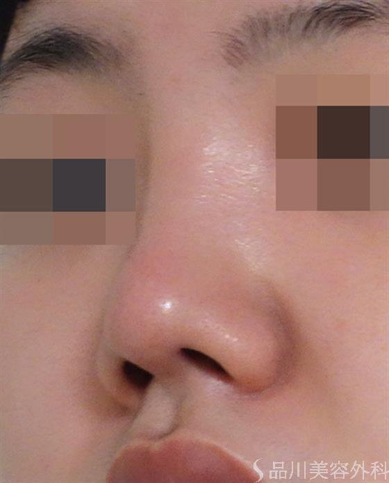 症例NO.40272のAFTER写真
