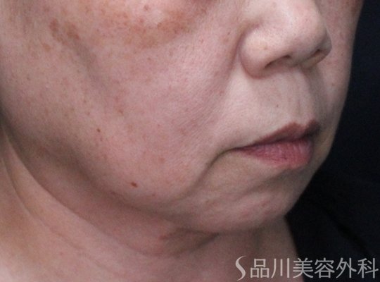 症例NO.74093のBEFORE写真
